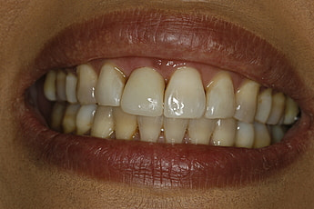 A close up of a woman's teeth before and after teeth whitening.